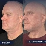 Before and after neck lift results at Dr. Safa Manav Clinic, improved jawline definition