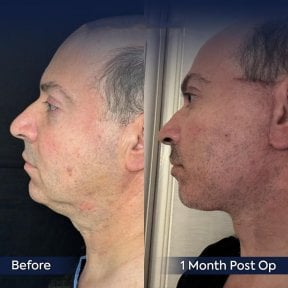 Before and after neck lift results at Dr. Safa Manav Clinic, visible jawline improvement