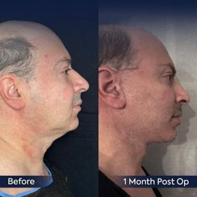 Before and after neck lift results at Dr. Safa Manav Clinic, visible jawline improvement