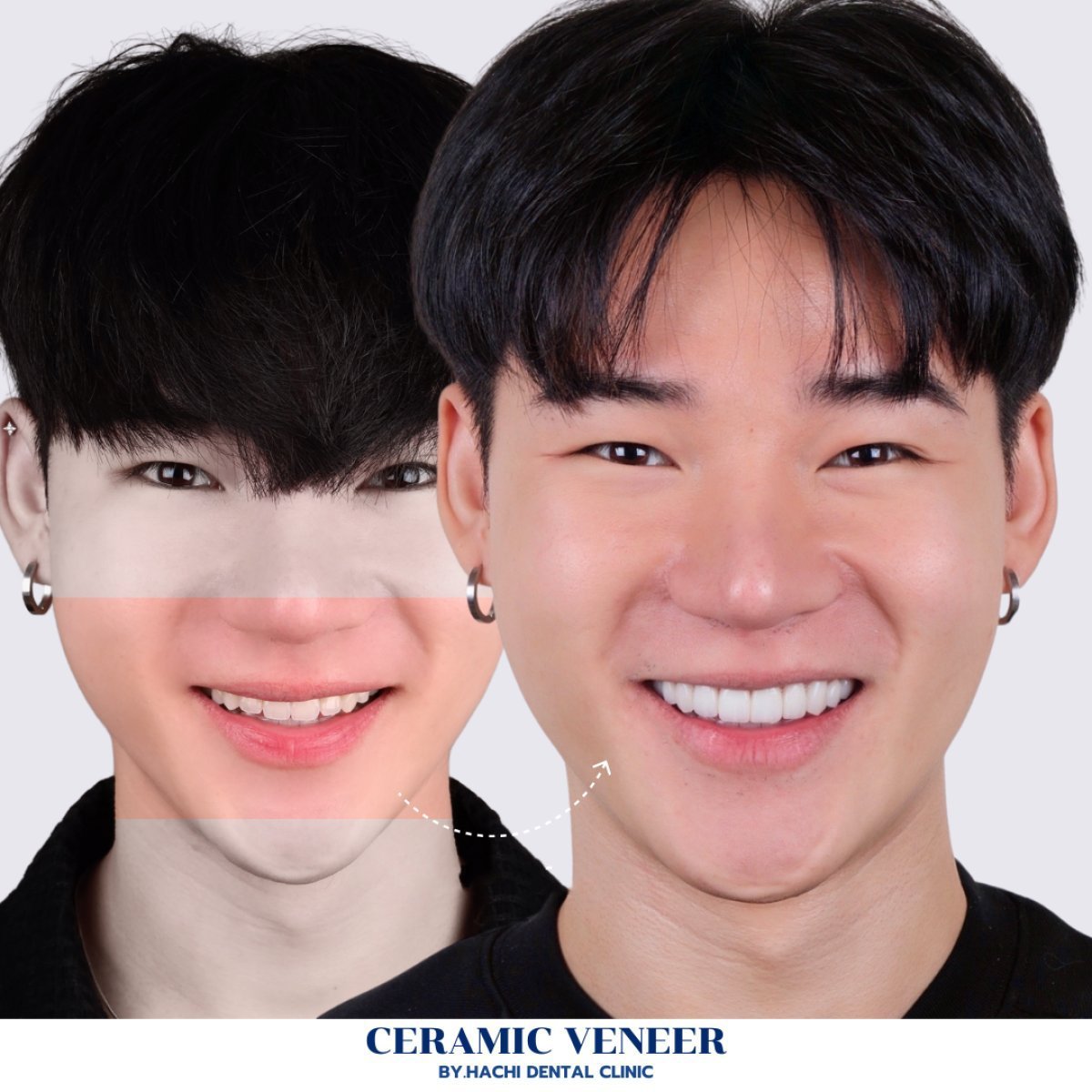Vorher-nachher-Ergebnis Keramikveneers bei Hachi Dental Clinic, verbesserte Ästhetik