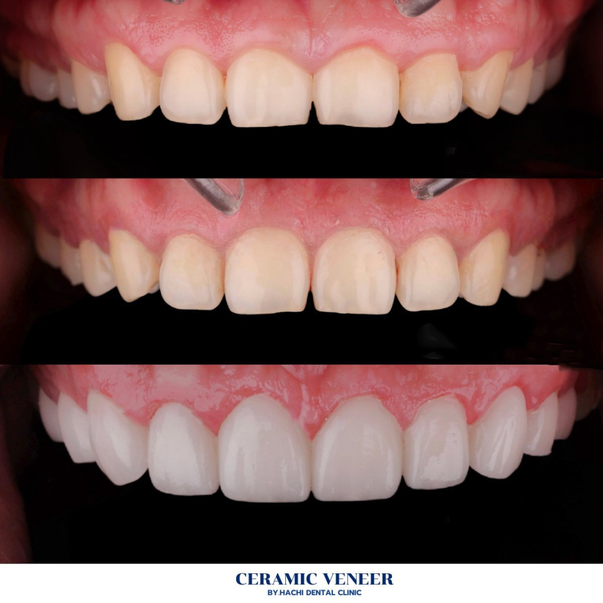 Vorher-nachher-Ergebnis Keramikveneers bei Hachi Dental Clinic, Lächeln-Transformation
