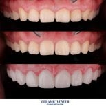 Avant et après facettes céramiques à Hachi Dental Clinic, résultat sourire transformé