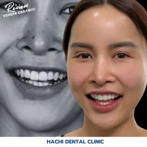 Vorher-nachher-Ergebnisse von Porzellanveneers bei Hachi Dental Clinic, sichtbare Veränderung