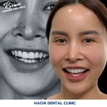 Vorher-nachher-Ergebnisse von Porzellanveneers bei Hachi Dental Clinic, sichtbare Veränderung