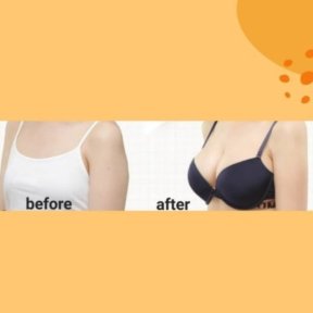 Before and after breast augmentation results at ID Clinic Bangkok, enhanced breast volume