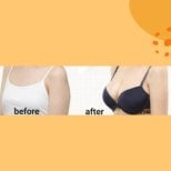 Before and after breast augmentation results at ID Clinic Bangkok, enhanced breast volume