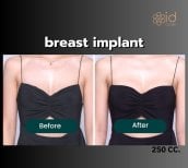 Resultados de aumento de senos antes y después en ID Clinic Bangkok con implantes de 250cc