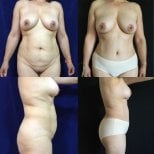 Before and after breast lift results at Marroquín & Sandoval Plastic Surgery Clinic, improved contour