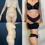 Before and after breast lift results at Marroquín & Sandoval Plastic Surgery Clinic, improved contour