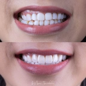 Vorher-nachher-Ergebnisse von Porzellanveneers bei About Tooth Dental Clinic, Lächeln-Transformation