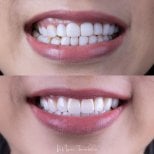 Vorher-nachher-Ergebnisse von Porzellanveneers bei About Tooth Dental Clinic, Lächeln-Transformation