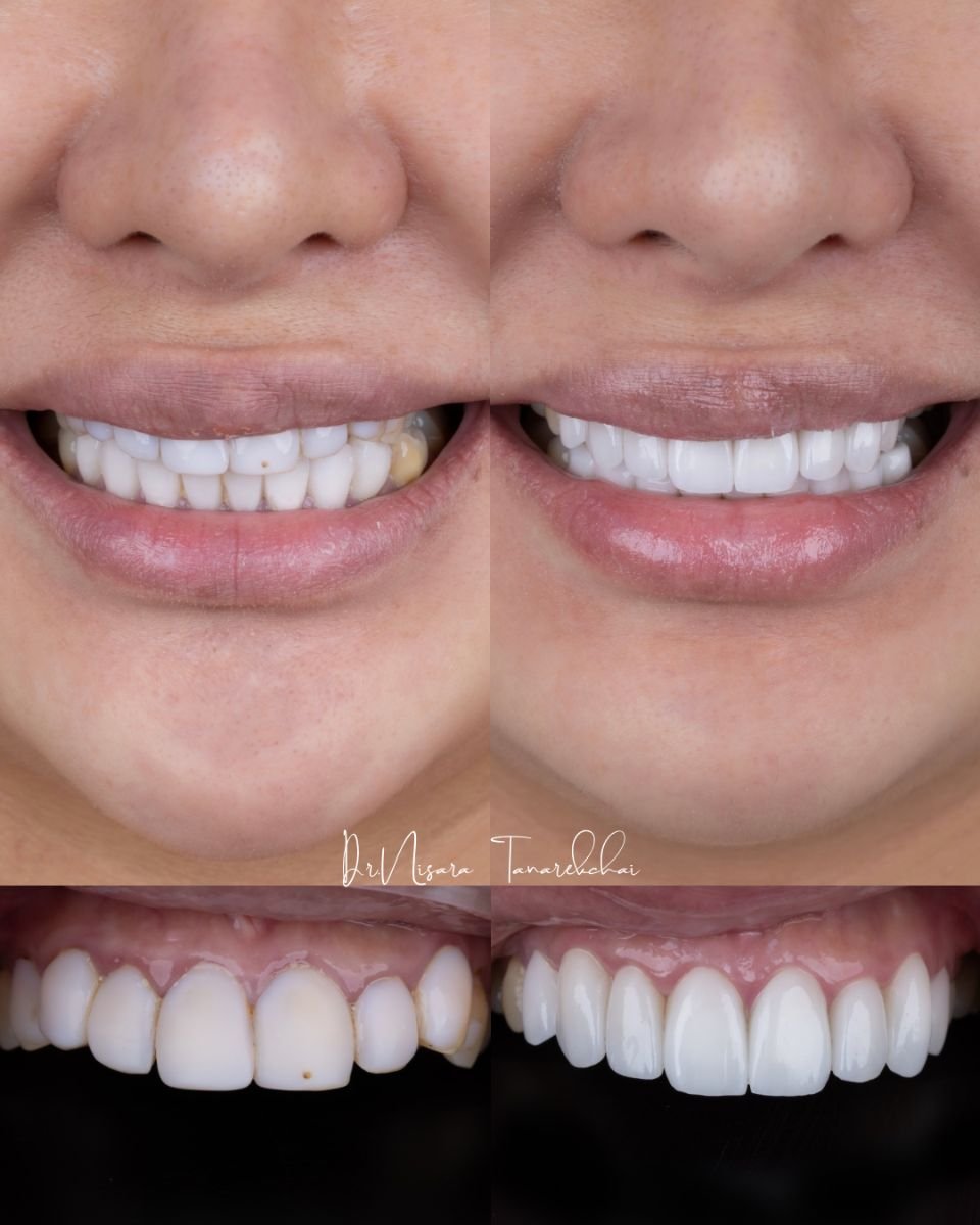 نتائج قبل وبعد عدسات الأسنان الخزفية في About Tooth Dental Clinic، تحول الابتسامة