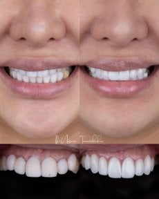 Vorher-nachher-Ergebnis Porzellanveneers bei About Tooth Dental Clinic, Lächeln-Transformation