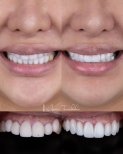 Vorher-nachher-Ergebnis Porzellanveneers bei About Tooth Dental Clinic, Lächeln-Transformation