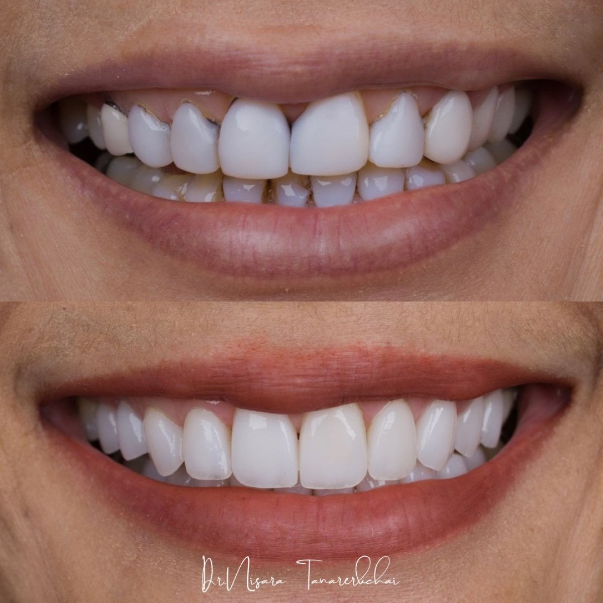 Resultados antes y después de carillas de porcelana en About Tooth Dental Clinic, cambio de sonrisa