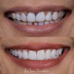 Vorher-nachher-Ergebnis von Keramikveneers bei About Tooth Dental Clinic, Smile-Makeover