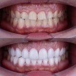 Vorher-nachher-Ergebnis von Keramikveneers bei About Tooth Dental Clinic, Lächeln-Transformation