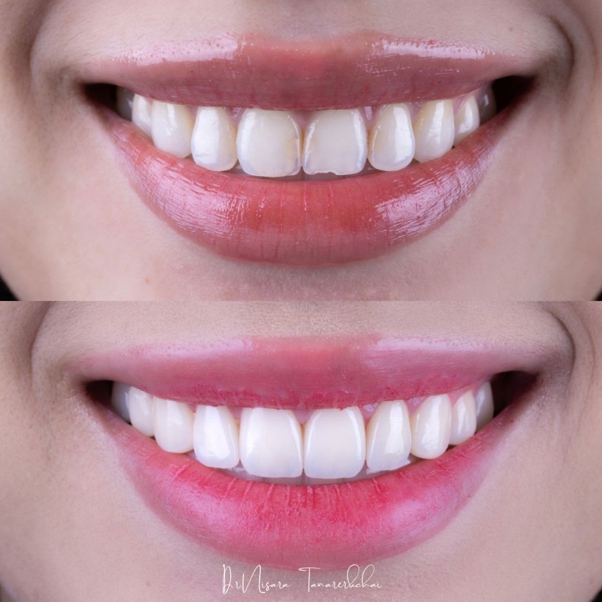 نتائج قبل وبعد عدسات الأسنان الخزفية في About Tooth Dental Clinic، تجميل الابتسامة