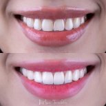 Vorher-nachher-Ergebnis Porzellanveneers bei About Tooth Dental Clinic, Lächeln