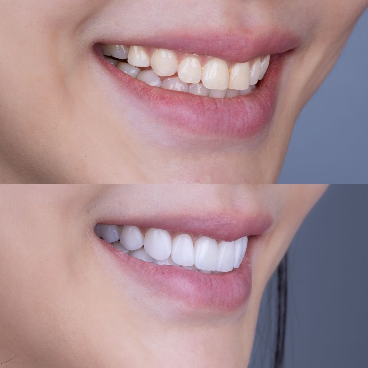 Resultados antes y después de carillas de porcelana en About Tooth Dental Clinic – sonrisa brillante