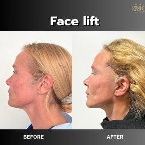 Facelift before and after results at ID Clinic Bangkok – visible facial contour improvement