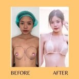 Before and after breast augmentation results at ID Clinic Bangkok, enhanced breast shape