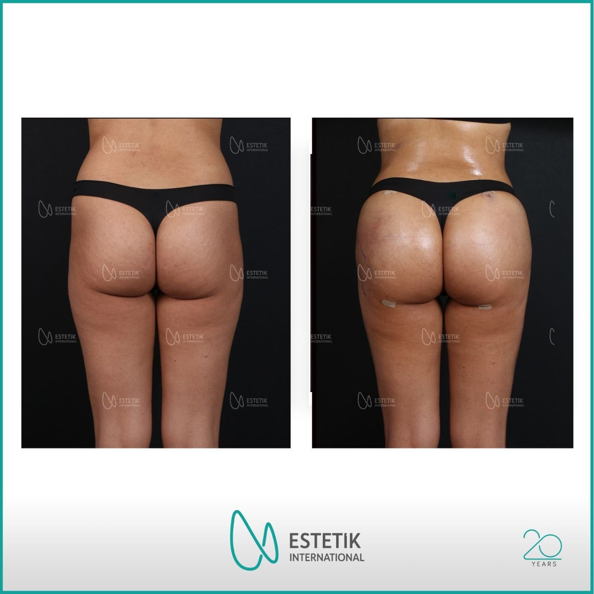 نتائج قبل وبعد عملية Brazilian Butt Lift في Estetik International Istanbul، منحنيات محسنة