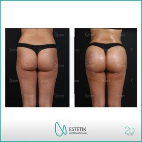 نتائج قبل وبعد عملية Brazilian Butt Lift في Estetik International Istanbul، منحنيات محسنة