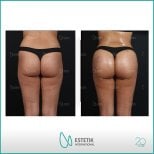 نتائج قبل وبعد عملية Brazilian Butt Lift في Estetik International Istanbul، منحنيات محسنة