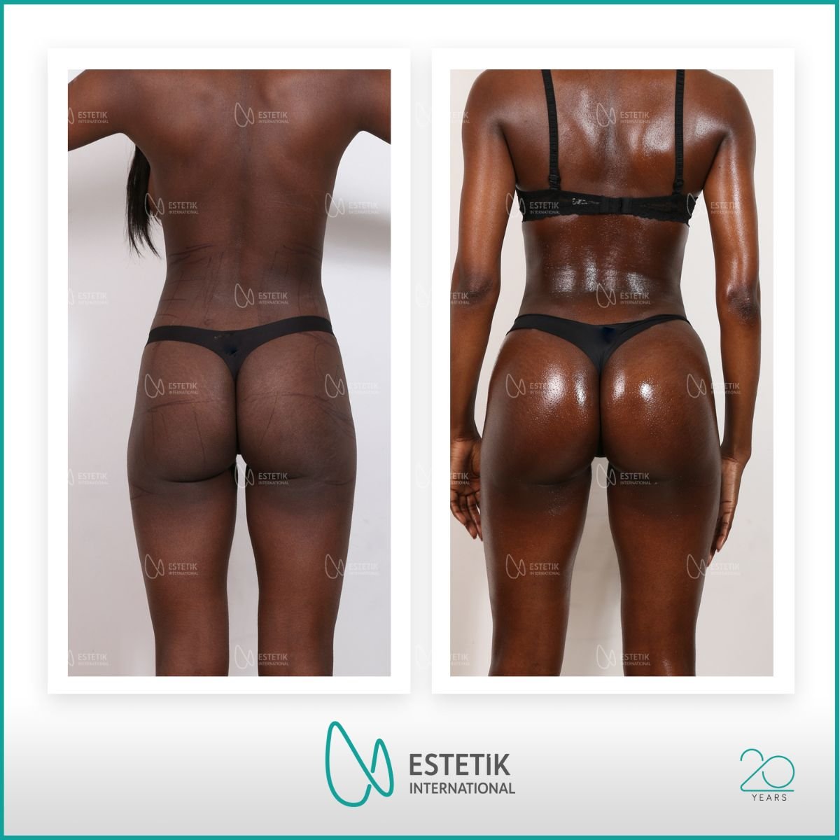 نتائج قبل وبعد عملية Brazilian Butt Lift في Estetik International Istanbul، منحنيات محسنة