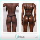 نتائج قبل وبعد عملية Brazilian Butt Lift في Estetik International Istanbul، منحنيات محسنة