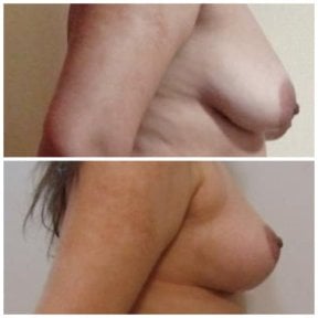 Before and after mammoplasty results at Istanbul Aesthetic Plastic Surgery Center, breast lift