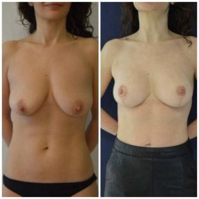 Before and after mammoplasty results at Istanbul Aesthetic Plastic Surgery Center, breast lift