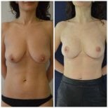 Before and after mammoplasty results at Istanbul Aesthetic Plastic Surgery Center, breast lift