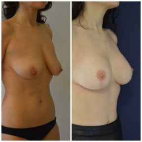 Before and after mammoplasty results at Istanbul Aesthetic Plastic Surgery Center, breast lift