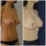 Before and after mammoplasty results at Istanbul Aesthetic Plastic Surgery Center, breast lift
