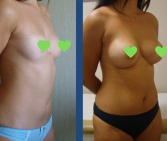 Before and after mammoplasty results at Istanbul Aesthetic Plastic Surgery Center, breast augmentation