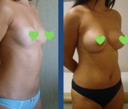 Before and after mammoplasty results at Istanbul Aesthetic Plastic Surgery Center, breast augmentation