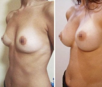 Resultados de mamoplastia antes y después en Istanbul Aesthetic Plastic Surgery Center, aumento de senos