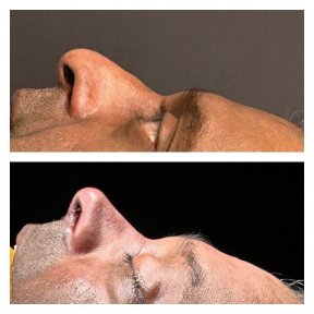 Before and after rhinoplasty results at Memorial Şişli Hospital, improved nose profile