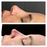 Before and after rhinoplasty results at Memorial Şişli Hospital, improved nose profile