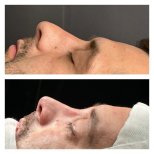 Before and after rhinoplasty results at Memorial Şişli Hospital, improved nose profile