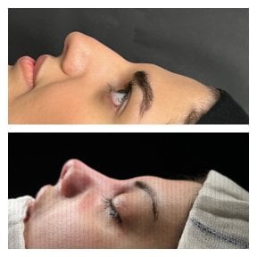 Résultats avant et après rhinoplastie à Memorial Şişli Hospital, profil du nez amélioré