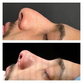 Résultats avant et après rhinoplastie à Memorial Şişli Hospital, profil du nez amélioré