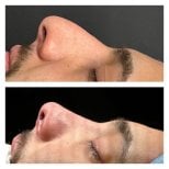 Résultats avant et après rhinoplastie à Memorial Şişli Hospital, profil du nez amélioré