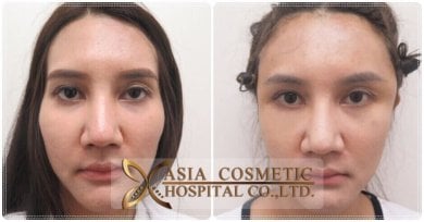 Résultats avant/après de la féminisation faciale à Asia Cosmetic Hospital, traits adoucis
