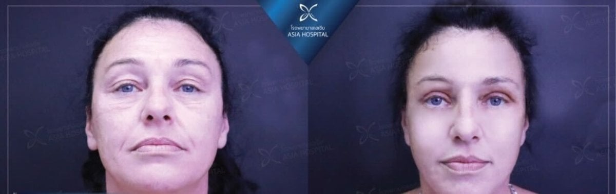 Résultats avant/après de féminisation faciale à Asia Cosmetic Hospital, traits adoucis