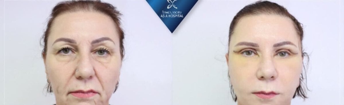 Résultats avant/après de la chirurgie de féminisation faciale à Asia Cosmetic Hospital, contours améliorés