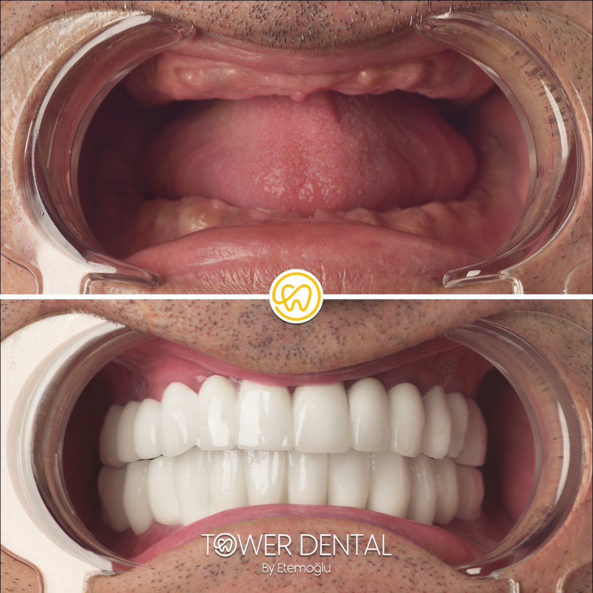 نتائج قبل وبعد زراعة الأسنان في Tower Dental Clinic – استعادة الابتسامة الكاملة