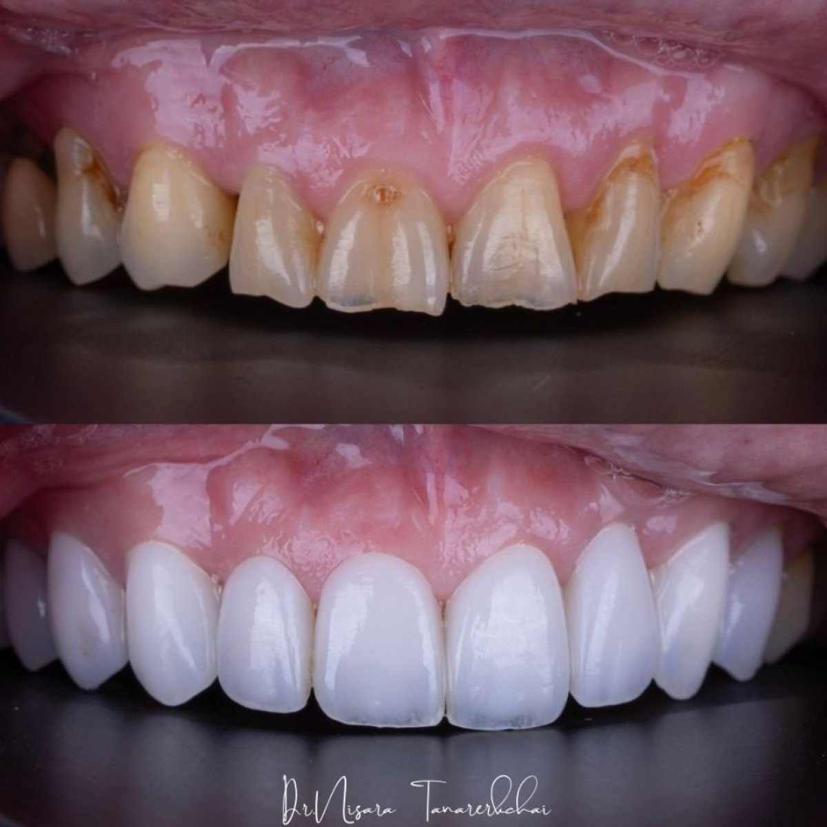 Resultados antes y después de carillas de porcelana en About Tooth Dental Clinic, transformación de sonrisa